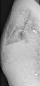 orthopedie, kyphoscoliose, funs lemmens, marfan, MUMC, aortaklep 