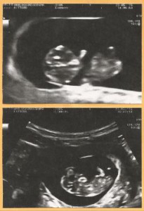 marfan syndroom, echo baby, funs lemmens