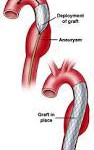marfan syndroom symptomen aortadilatatie, funslemmensmarfan, klinische genetica, erfelijkheid, symptomen marfan syndroom