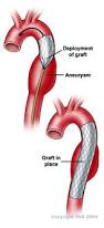 marfan syndroom symptomen aortadilatatie, funslemmensmarfan, klinische genetica, erfelijkheid, symptomen marfan syndroom