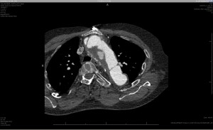 scan rommelige aortabocht 2014, ct scan, aorta bocht, AZM, marfan syndroom, funslemmensmarfan