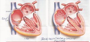 uitleg boezemflutter, hartritmestoring, marfan patient, marfan syndroom,