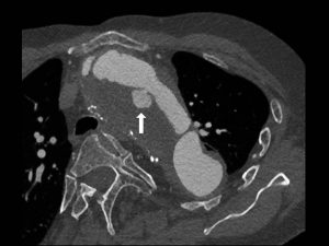 aortaboog operatie 6, CT scan funs lemmens kunsstof aorta lek 2019