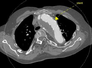 ct scan, marfan funs lemmens, MUMC, Prof Schurink, 