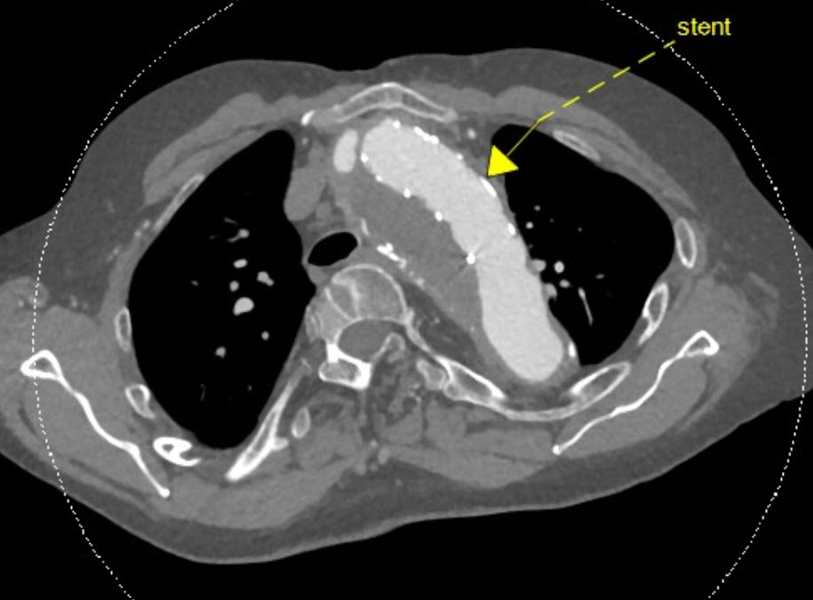 ct scan, marfan funs lemmens, MUMC, Prof Schurink,