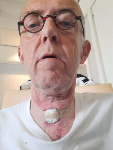 dop op gaatje trachio, BPAP machine, Canule laten verwijderen op IC MUMC, funs lemmens, marfan syndroom, MUMC IC