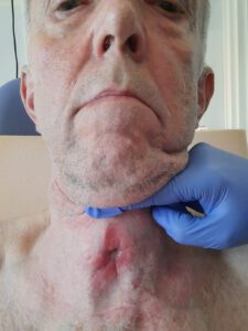 gaatje trachio, BPAP machine, Canule laten verwijderen op IC MUMC, funs lemmens, marfan syndroom, MUMC IC