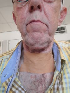 verbonden trachio, BPAP machine, Canule laten verwijderen op IC MUMC, funs lemmens, marfan syndroom, MUMC IC