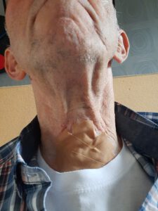 Controle van trachio-stoma bij KNO arts MUMC, funs lemmens, marfan syndroom, afdoppen van tachiostoma
