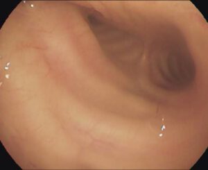 trachea juli 2020 hersteld